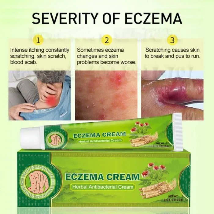 Crème anti-eczéma et antifongique